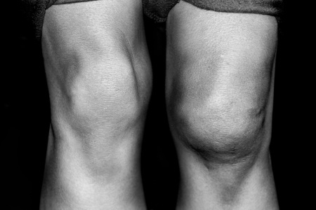 swollen-knee